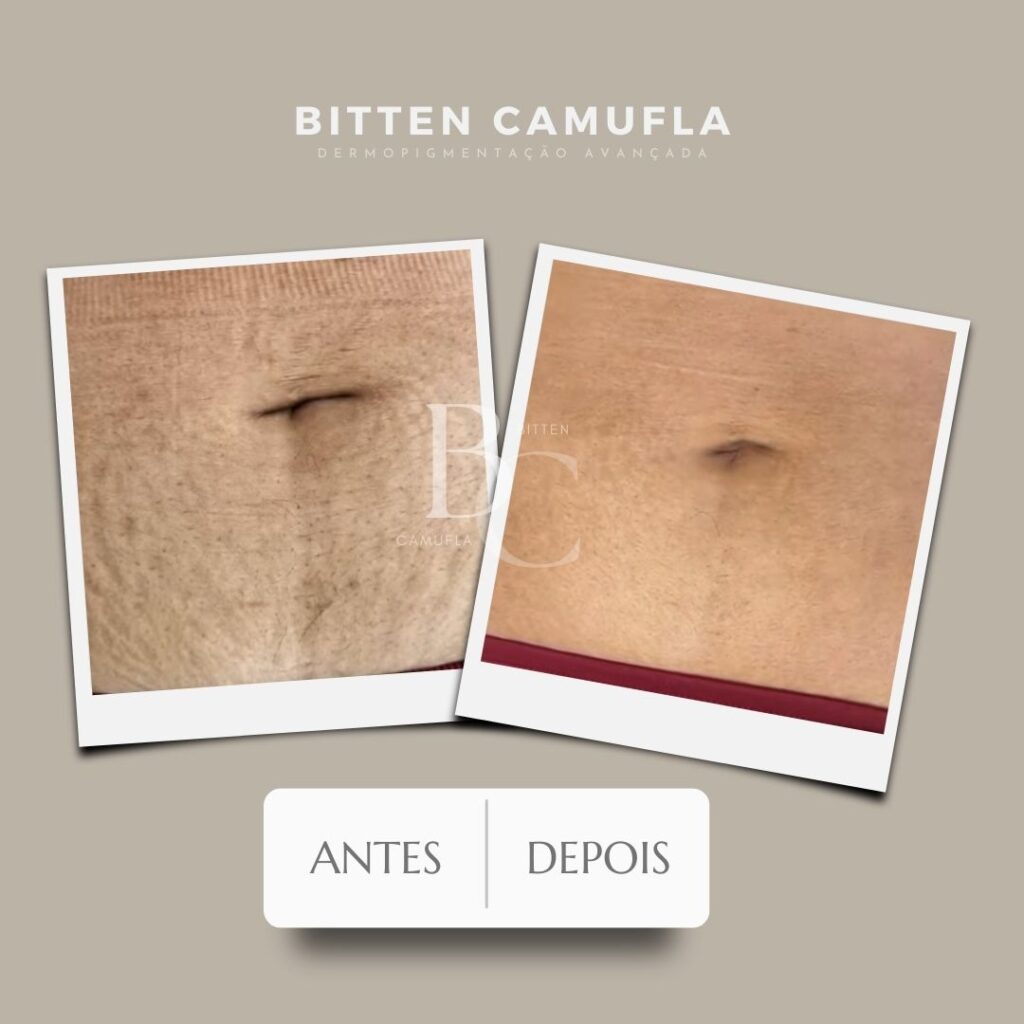 camuflagem para estrias