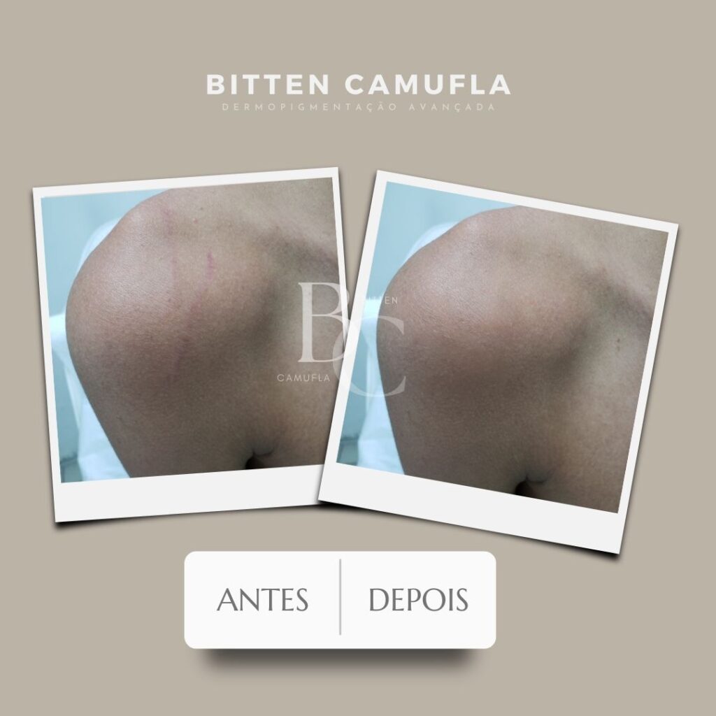 camuflagem para estrias