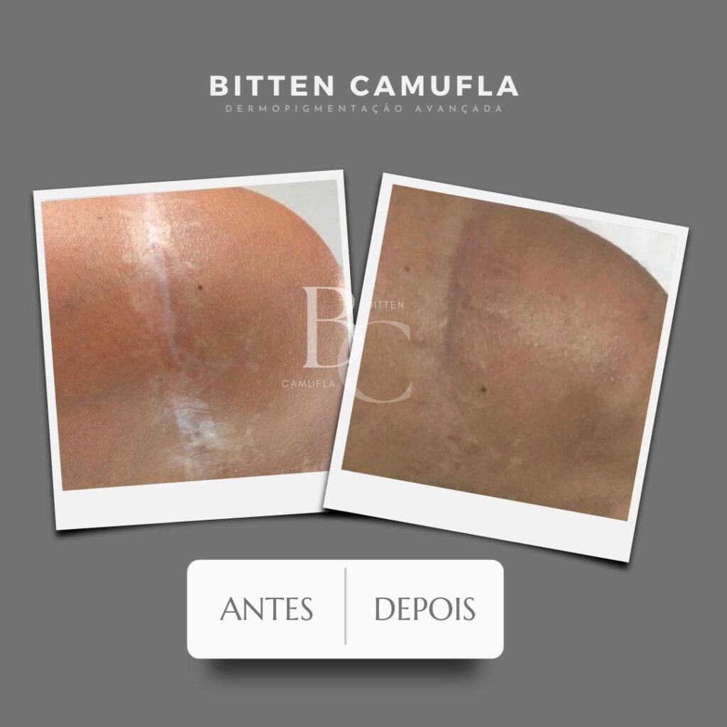 Camuflagem para cicatriz