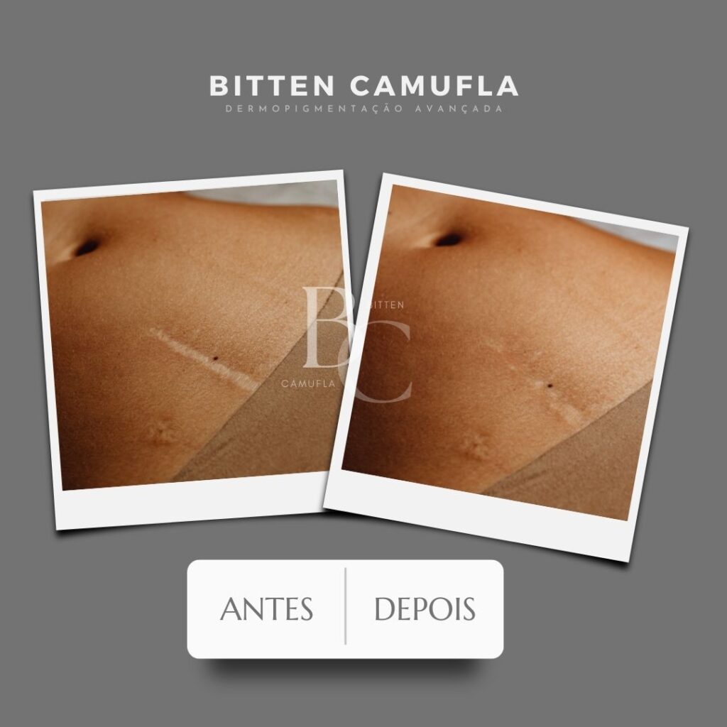 Camuflagem para cicatriz