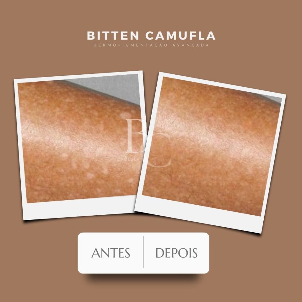 camuflagem para manchas na pele