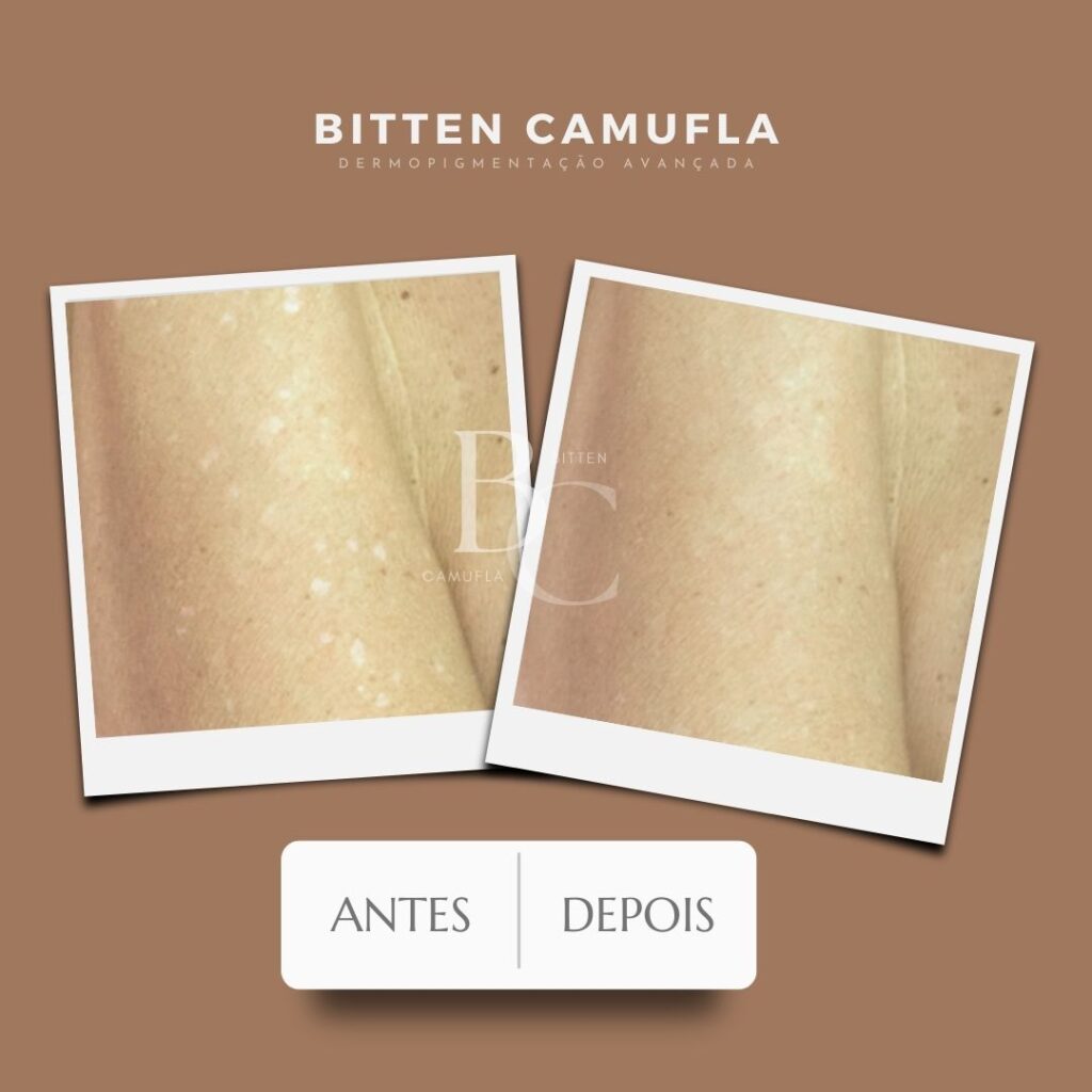 camuflagem para manchas na pele