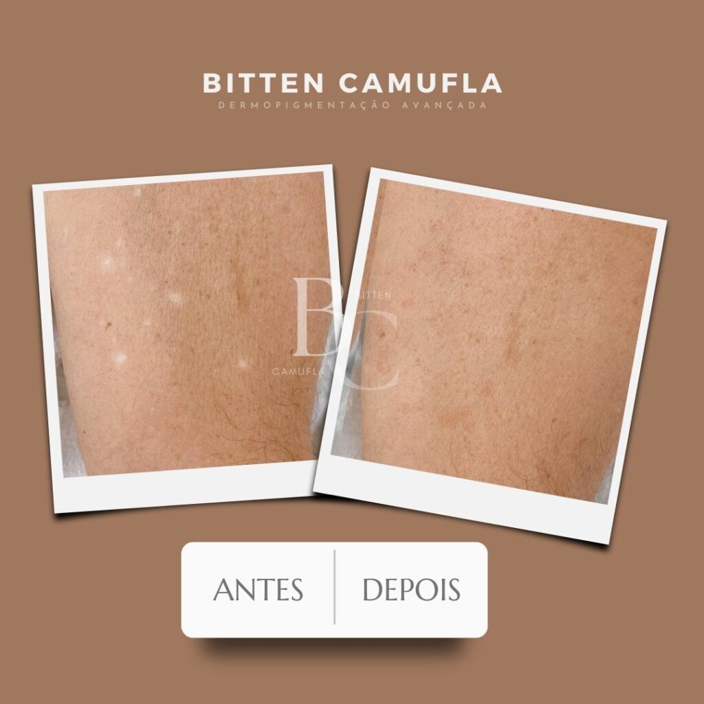 camuflagem para manchas na pele