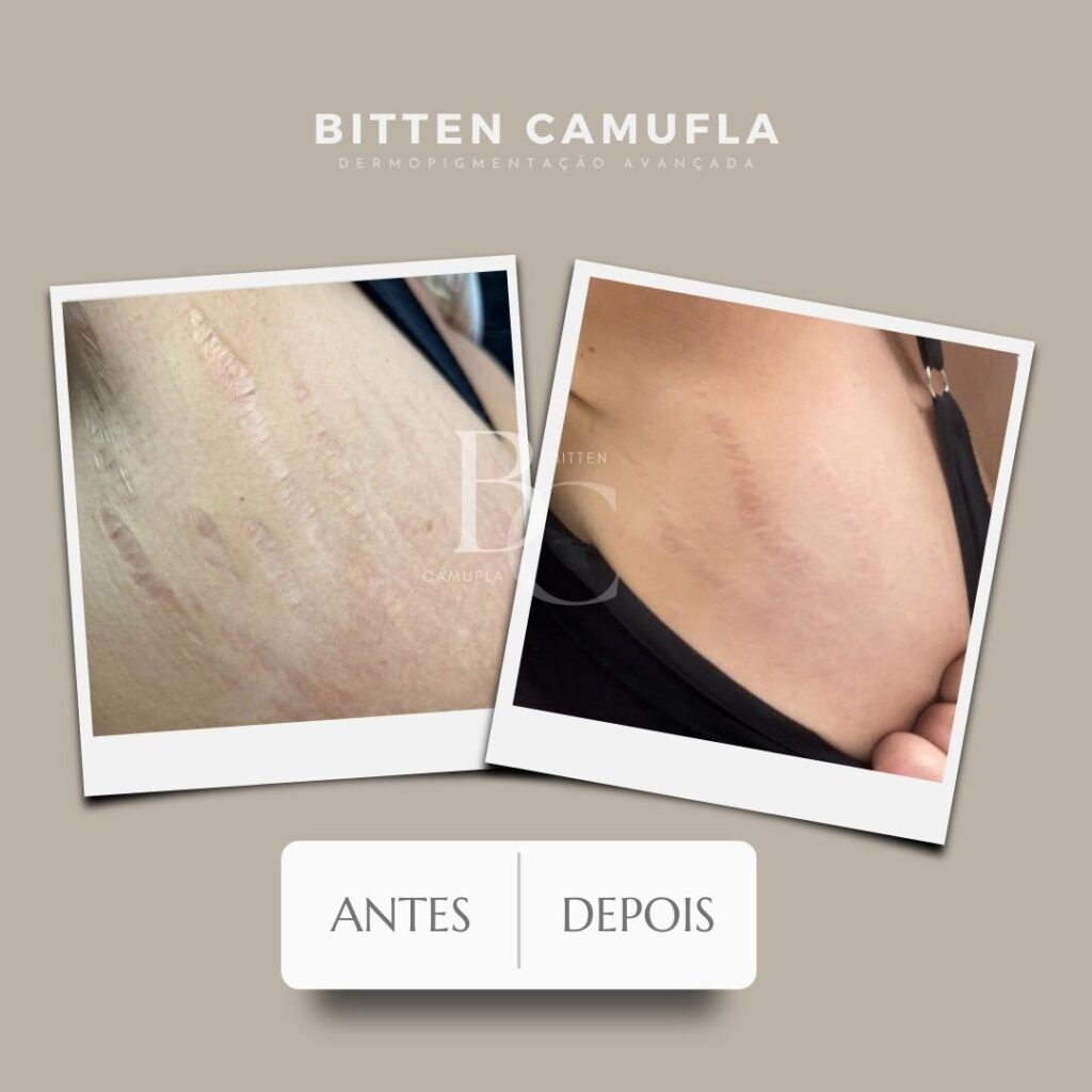 camuflagem para estrias